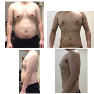 before/after(２カ月で-10キロの減量に成功の男性)